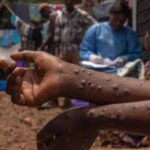 RDC/Santé:la Mpox fait 9 morts dans la Province du Kwilu